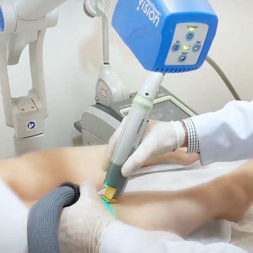 dr-marco-munia-medicina-vascular-atendimentos-laser-em-varizes